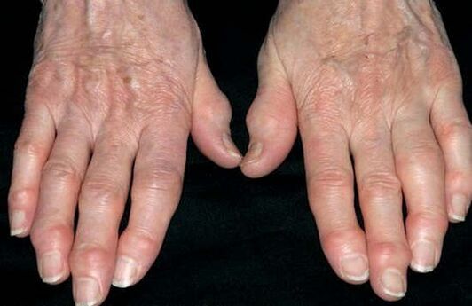 Arthritis