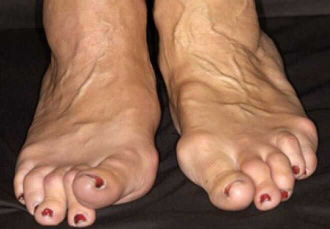 Deformity of arthrosis