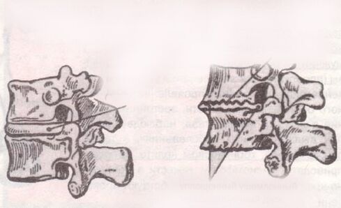 Intervertebral disc is healthy and with lumbar osteochondrosis