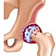 Arthrosis of the hip joint