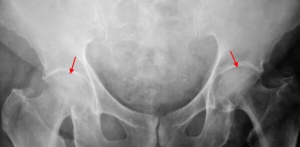 Two-sided creation of coxarthrosis-soustling of the joint gap, sclerosis of the articular surfaces