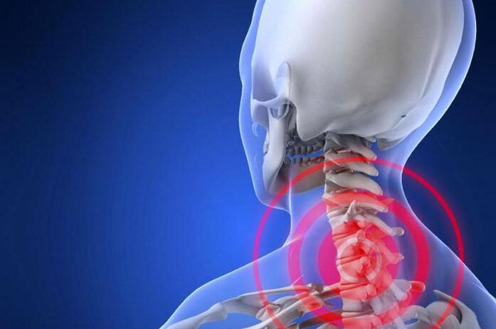 Neck pain is an early symptom of cervical osteochondrosis